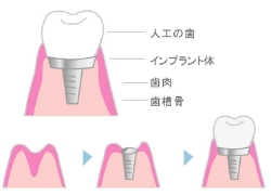 インプラント